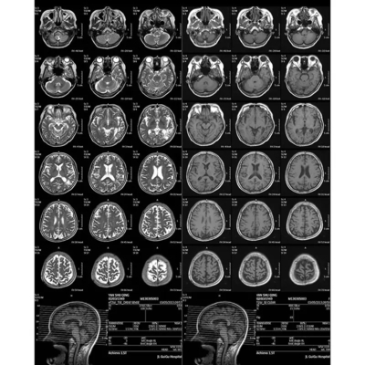 Film de radiographie médicale à usage unique réglé automatiquement en fonction de la densité