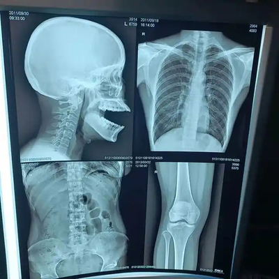 200±5 μM d'épaisseur Film de rayons X médical pour le diagnostic à haute densité