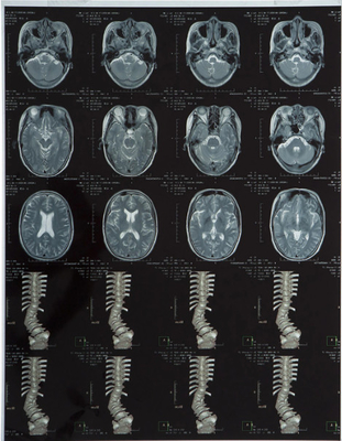 Film laser pour l'impression d'images médicales à rayons X