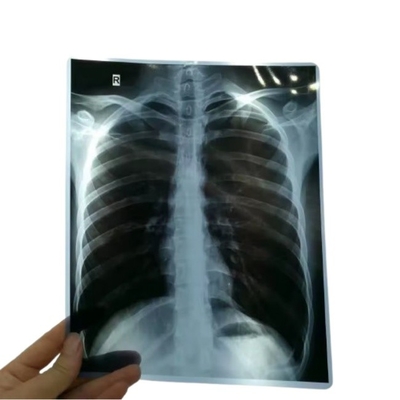 14*17 pouces de film d'analyse à sec pour radiographie médicale/CT/DR pour imprimante laser à rayons X et équipement d'impression thermique